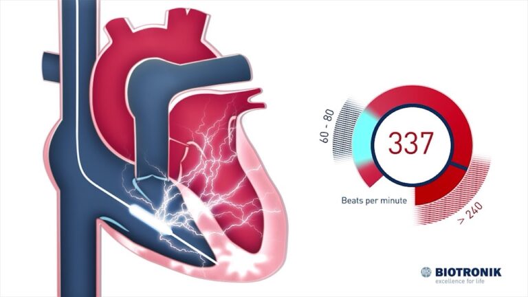 Cardio Desfibrilador Implantado: Benefícios e Cuidados Essenciais