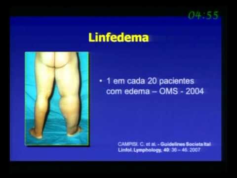 Entendendo o Edema no Membro Inferior: Causas e Tratamentos