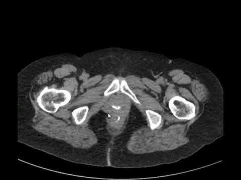 Fístula Retrovaginal: Causas, Sintomas e Tratamentos