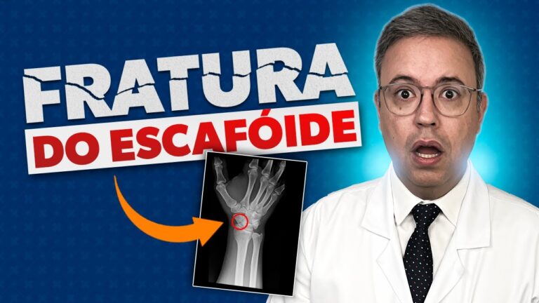 Tratamento Eficaz para Escafoide Quebrado