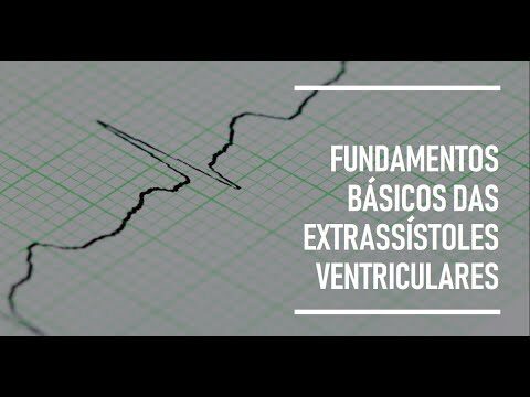 Extrassistole no ECG: Identificação e Implicações Clínicas