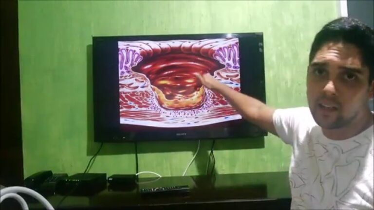 H. pylori e sua Relação com o Refluxo Gastroesofágico