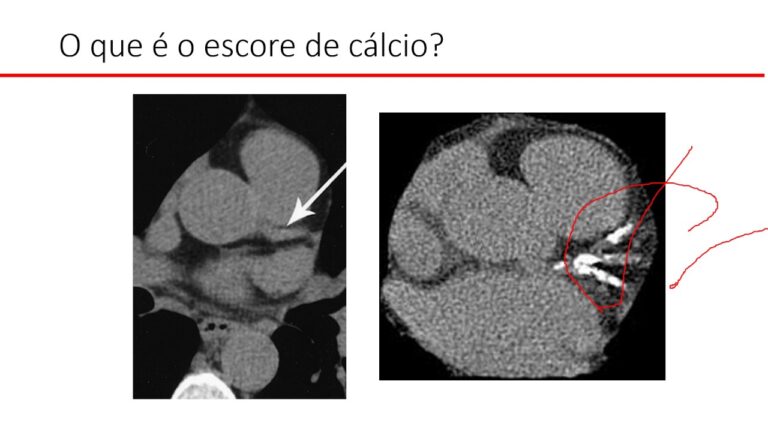 Escore de Calcio Coronariano: Importância e Interpretação