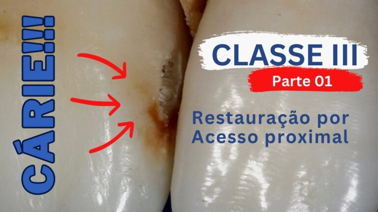 Entendendo a Cárie Proximal: Prevenção e Tratamento