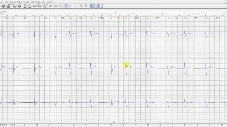 Tratamento Eficaz para Ritmo Juncional