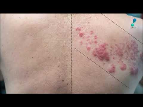 Herpes Zoster e Sua Relação com o Nervo Ciático