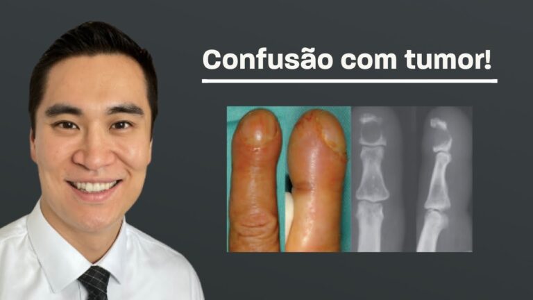 Cisto Epidérmico: Entenda a Relação com o Câncer