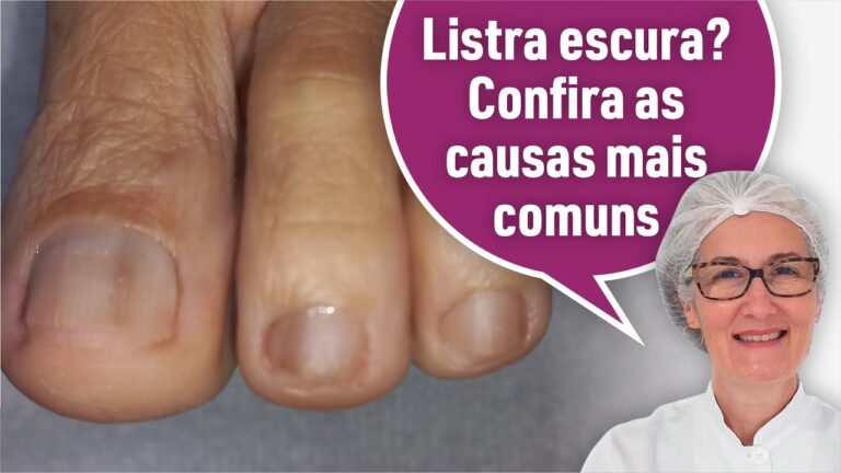 Listras Escuras nas Unhas: Causas e Tratamentos