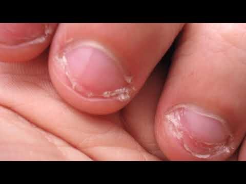 Verrugas Periungueais: Causas, Tratamentos e Prevenção