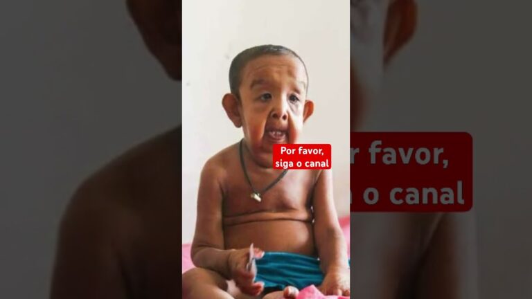 Entendendo a Síndrome Cutis Laxa: Causas e Tratamentos