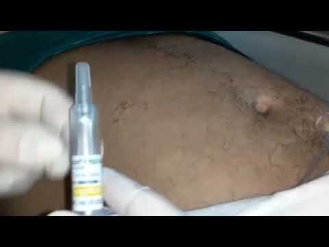 Eficácia da Enoxaparina Subcutânea na Prevenção de Complicações Tromboembólicas
