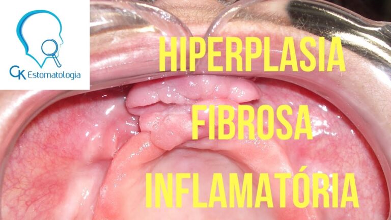 Entendendo a Fibrose na Boca: Causas e Tratamentos