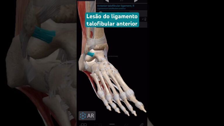Ruptura Completa do Ligamento Talofibular Anterior: Causas e Tratamentos