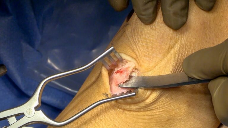Cirurgia para Osgood-Schlatter: Abordagens e Resultados