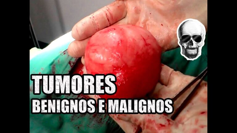 A Cor do Tumor Maligno: O Que Você Precisa Saber